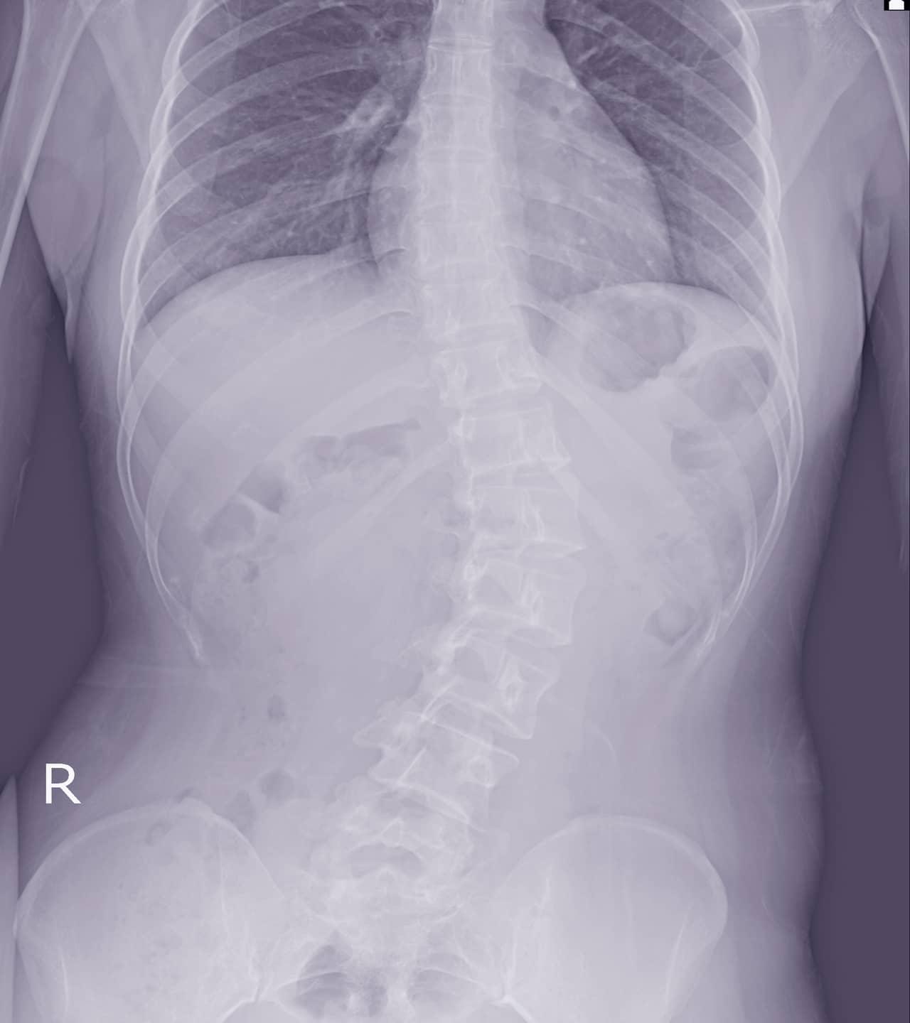 scoliosis- teen spine injury