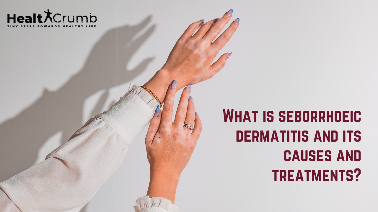 What is seborrhoeic dermatitis and its causes and treatments?